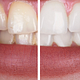 Teeth Whitening (40 mins)