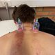 Cupping sportmassage -Of rug/nek