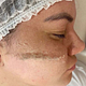 Dermafacial - Dermaplaning