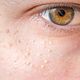 Facial especial Miliums