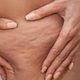 Celulitis