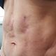 Trat. Para fibrosis post lipo