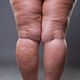 Lipedema treatment