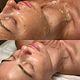 Botox Facial Firming and Lifting