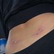 Surface back piercings