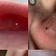 არხის გაწმენდა / Cleaning the piercing channel