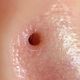 ძველი არხის აღდგენა / Restoration of an old healed piercing