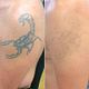 Tattoo Removal