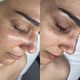 Dermaplane