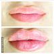 Dermal Fillers
Consultation in Clinic