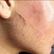 Dermaplaning Facial