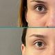 Despigmentación de Ojeras/ Parpados