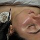Dermafacial