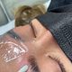Brow Lift