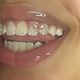 toothgem sets