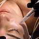 Microneedling