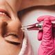 Tratamiento con Dermapen
