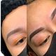 Brow Reconstruction