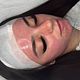 Microneedling