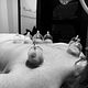 Hijama cupping nat