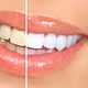 American Teeth Whitening  