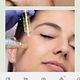 Microneedling