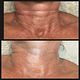 RF TREATMENT
