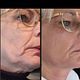 RF TREATMENT