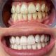 VIP smile