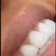 Hollywood smile