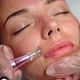 Microneedling