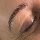 Brow Lift