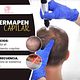 Dermapen capilar