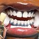 XtraBrite Teeth Whitening