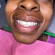 BriteSmile Teeth Whitening