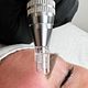 MICRONEEDLING