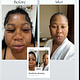 Face slimming