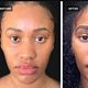 CHEEKS FILLER