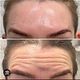 FOREHEAD|CROW FEET|BROW LIFT