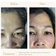UNDER EYE FILLER