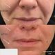 NASOLABIAL FILLER