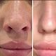 NOSE SLIMMING