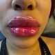 LIP FILLER