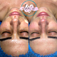 Dermapen con Sueros