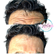 Botox