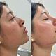 Armonización facial