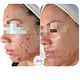 Tratamiento Acne