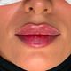 Aumento de labios