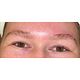 Brow Lift