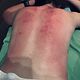 Healing cupping stress/ vermoeidheid